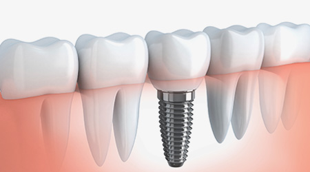 dental implants