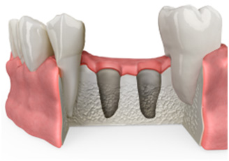 img bonegraft4