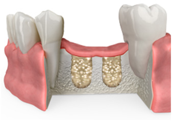 img bonegraft5