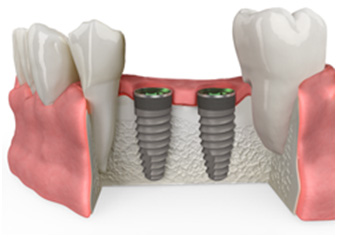 img bonegraft6