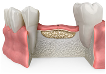 img bonegraft8